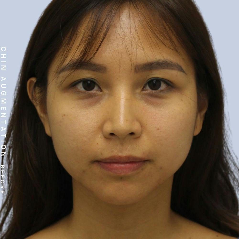 Chin Before & After Gallery - Patient 120145326 - Image 1