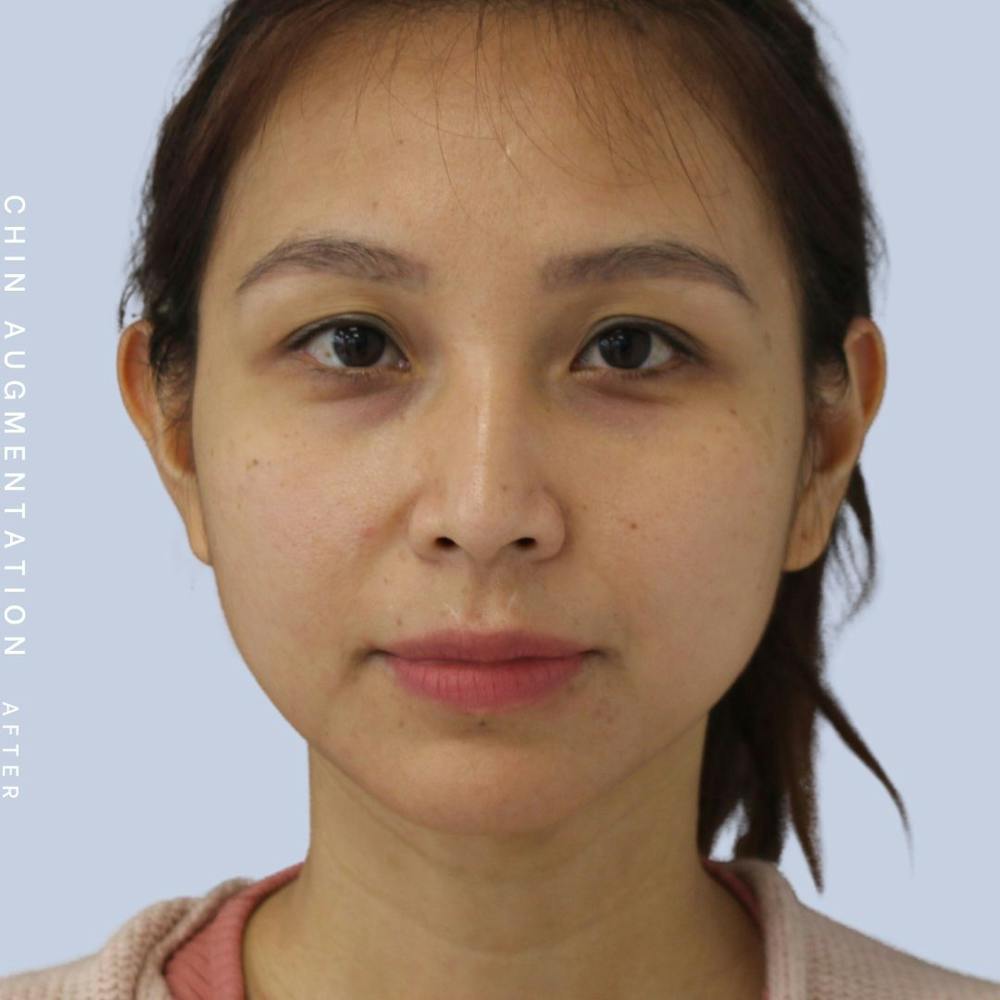 Chin Before & After Gallery - Patient 120145326 - Image 2