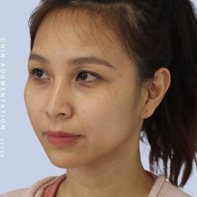 Chin Before & After Gallery - Patient 120145326 - Image 4