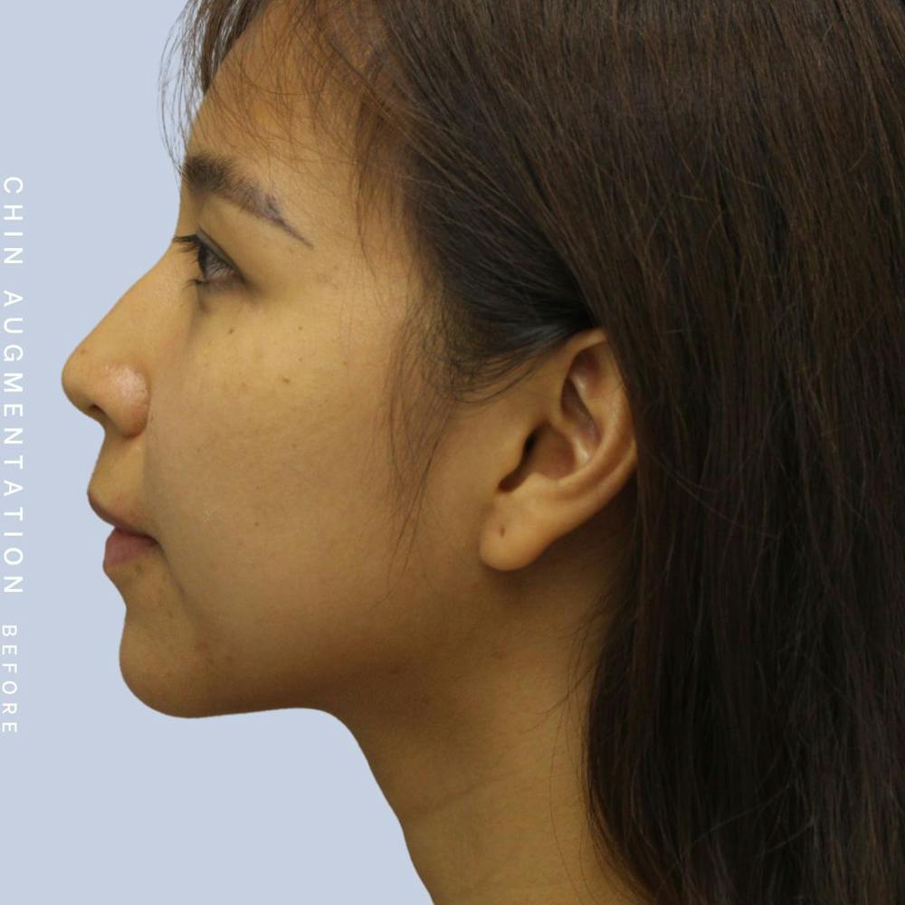 Chin Before & After Gallery - Patient 120145326 - Image 5