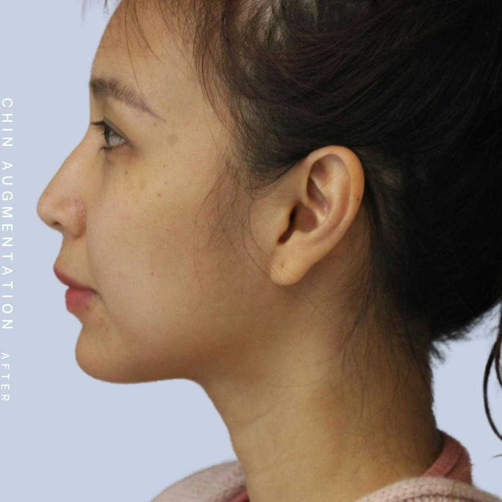 Chin Before & After Gallery - Patient 120145326 - Image 6