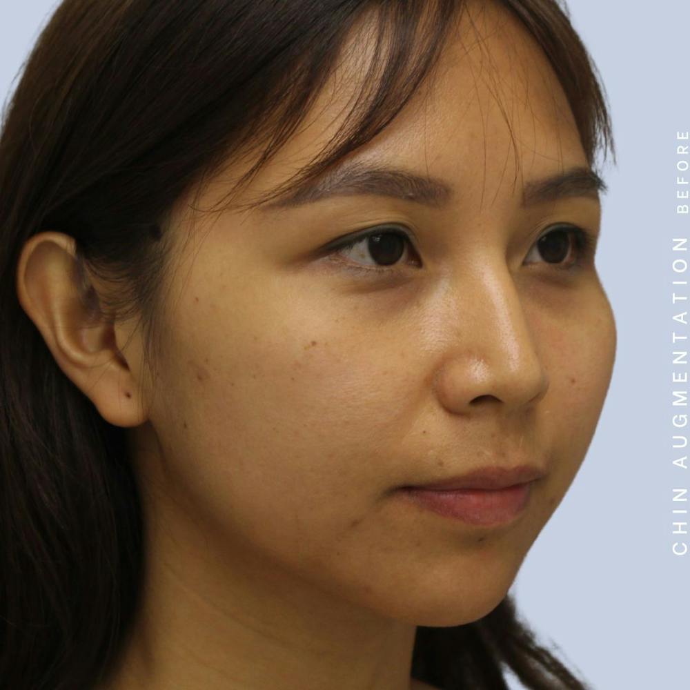 Chin Before & After Gallery - Patient 120145326 - Image 7