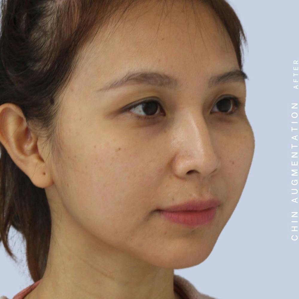 Chin Before & After Gallery - Patient 120145326 - Image 8