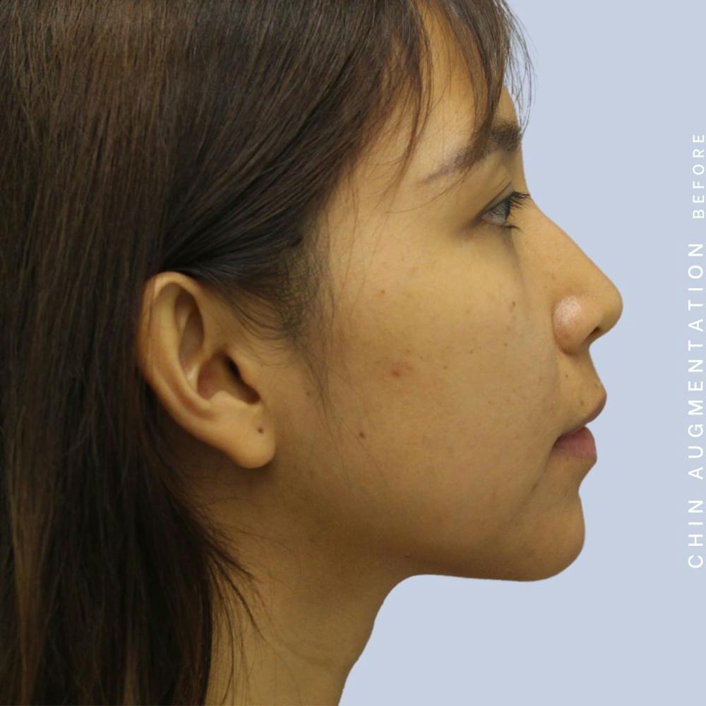 Chin Before & After Gallery - Patient 120145326 - Image 9