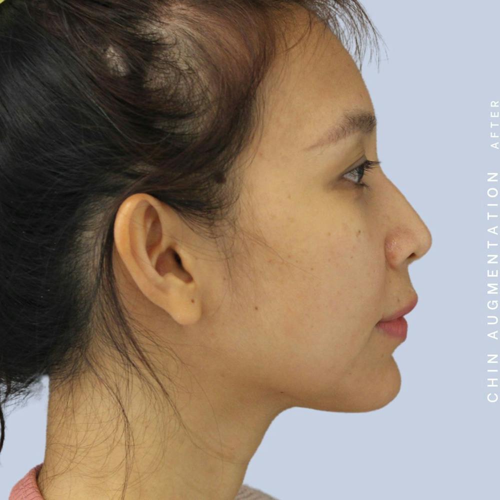 Chin Before & After Gallery - Patient 120145326 - Image 10