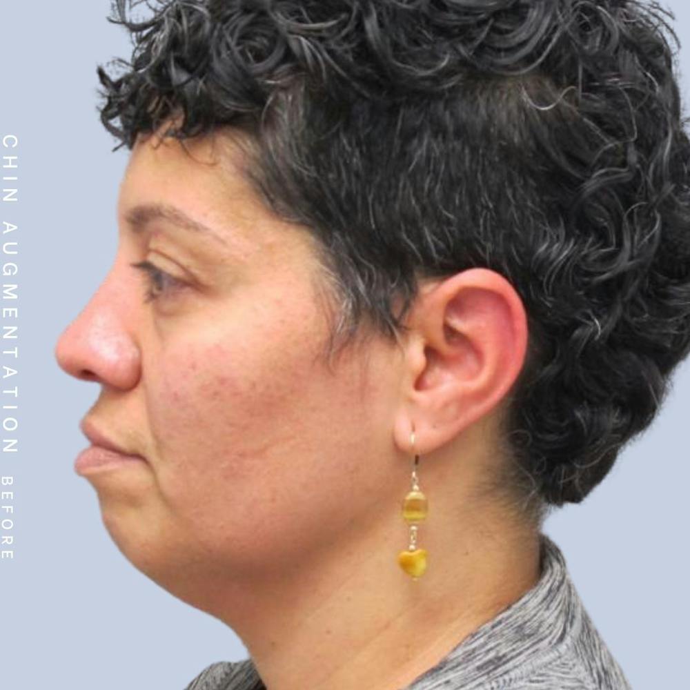 Chin Before & After Gallery - Patient 120145327 - Image 1