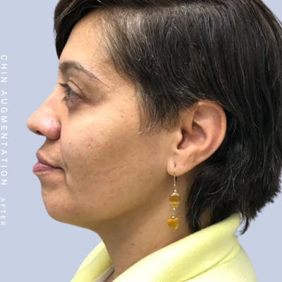 Chin Before & After Gallery - Patient 120145327 - Image 2
