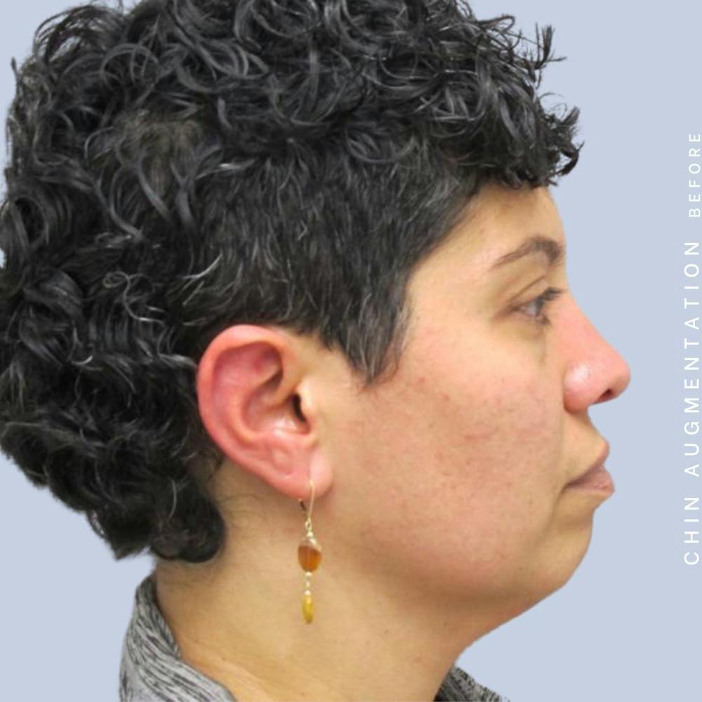 Chin Before & After Gallery - Patient 120145327 - Image 3