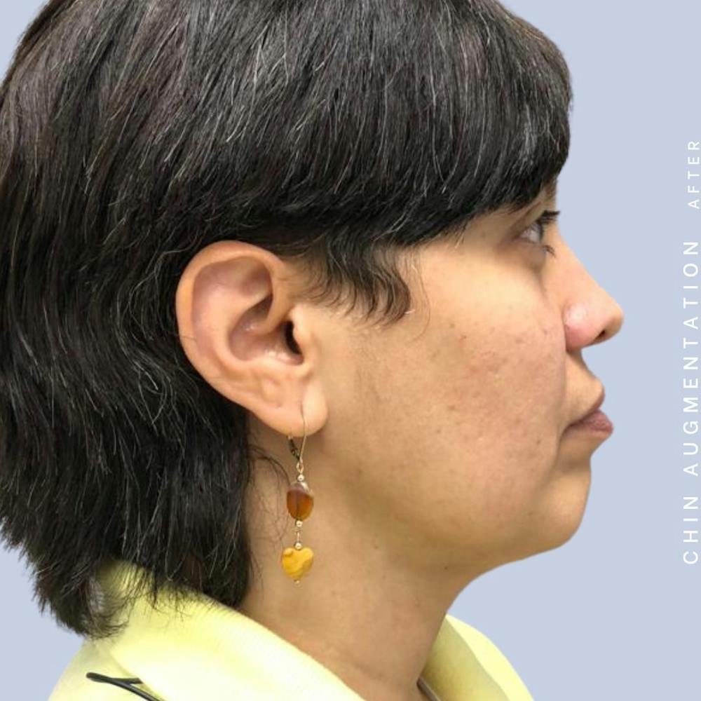 Chin Before & After Gallery - Patient 120145327 - Image 4