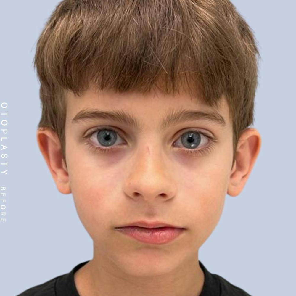Ears Before & After Gallery - Patient 122542485 - Image 1
