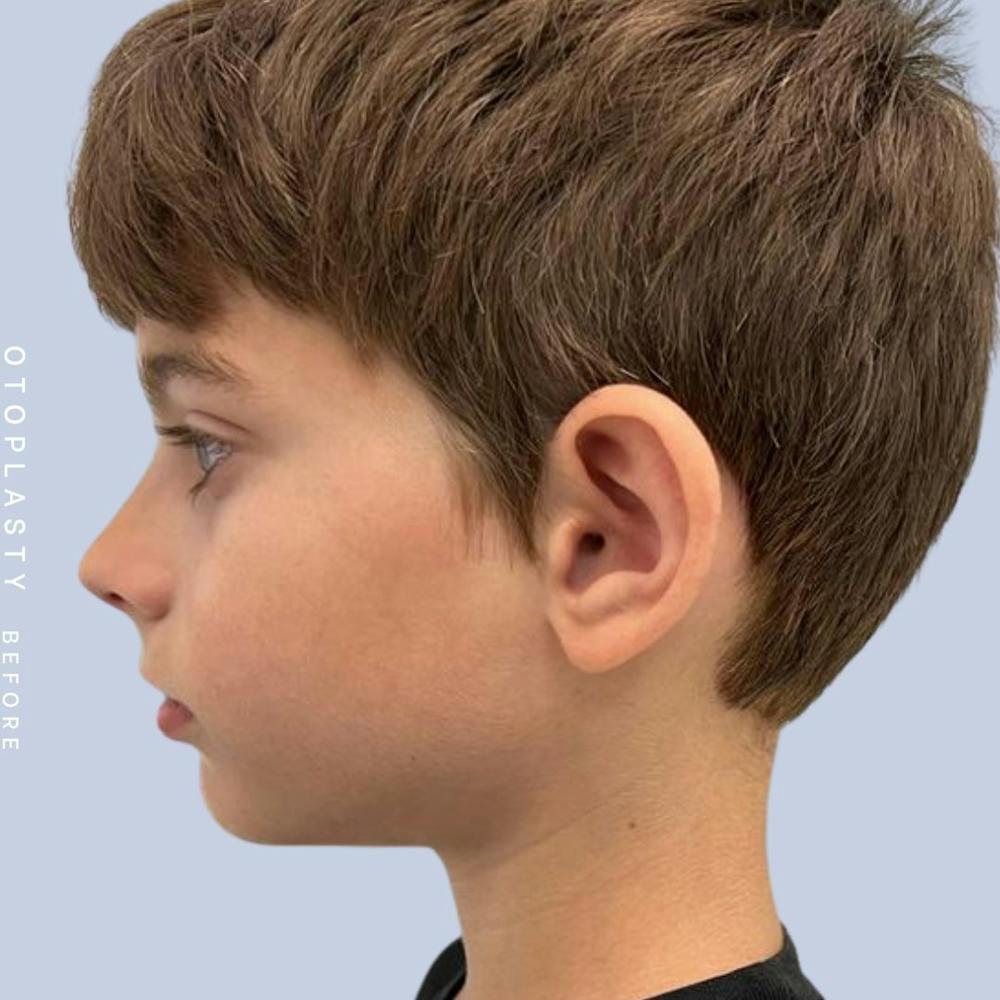 Ears Before & After Gallery - Patient 122542485 - Image 3