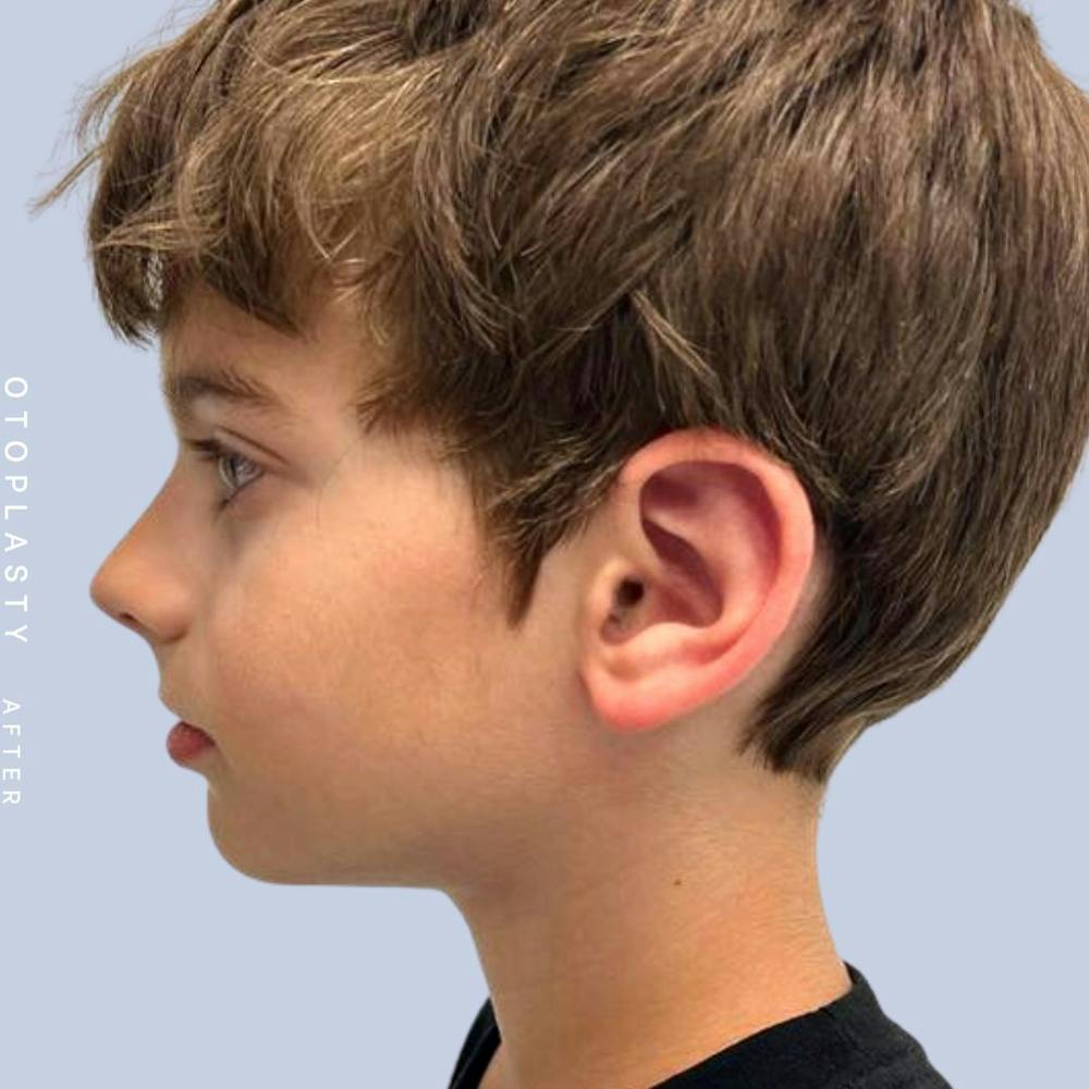 Ears Before & After Gallery - Patient 122542485 - Image 4