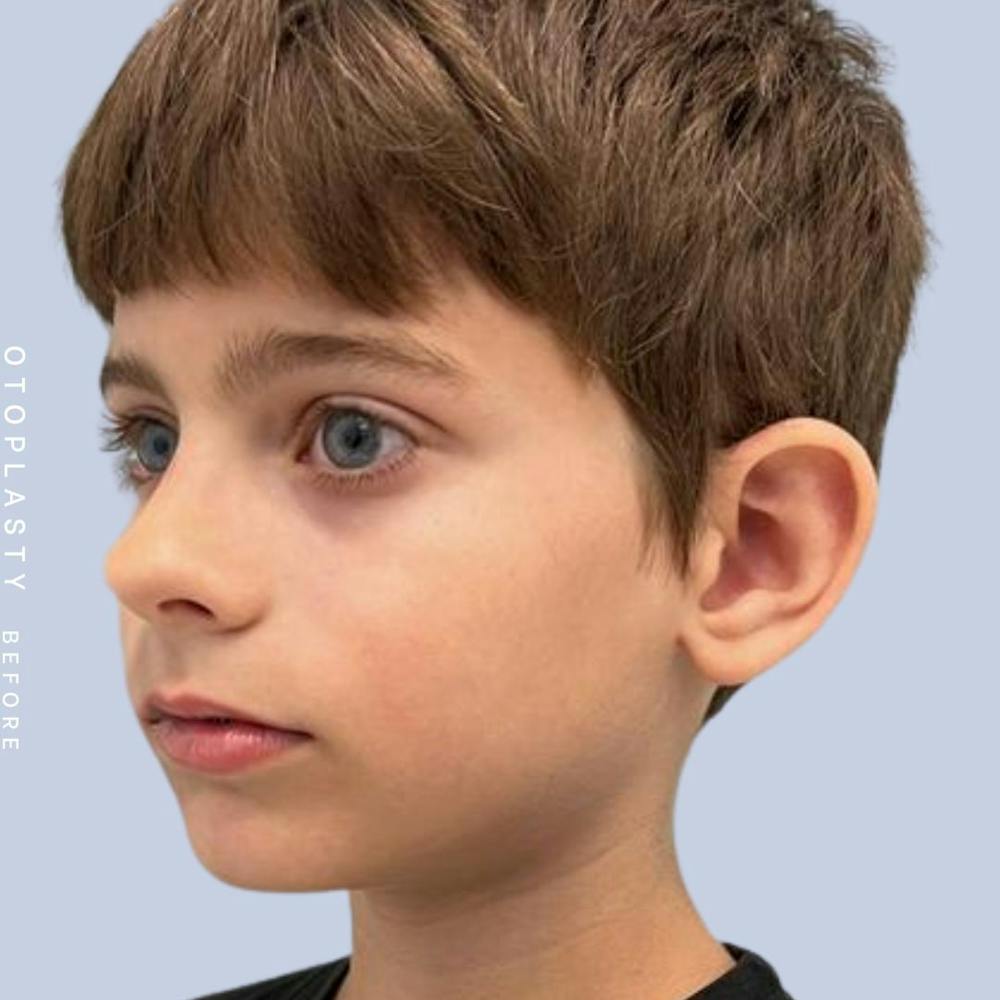 Ears Before & After Gallery - Patient 122542485 - Image 5