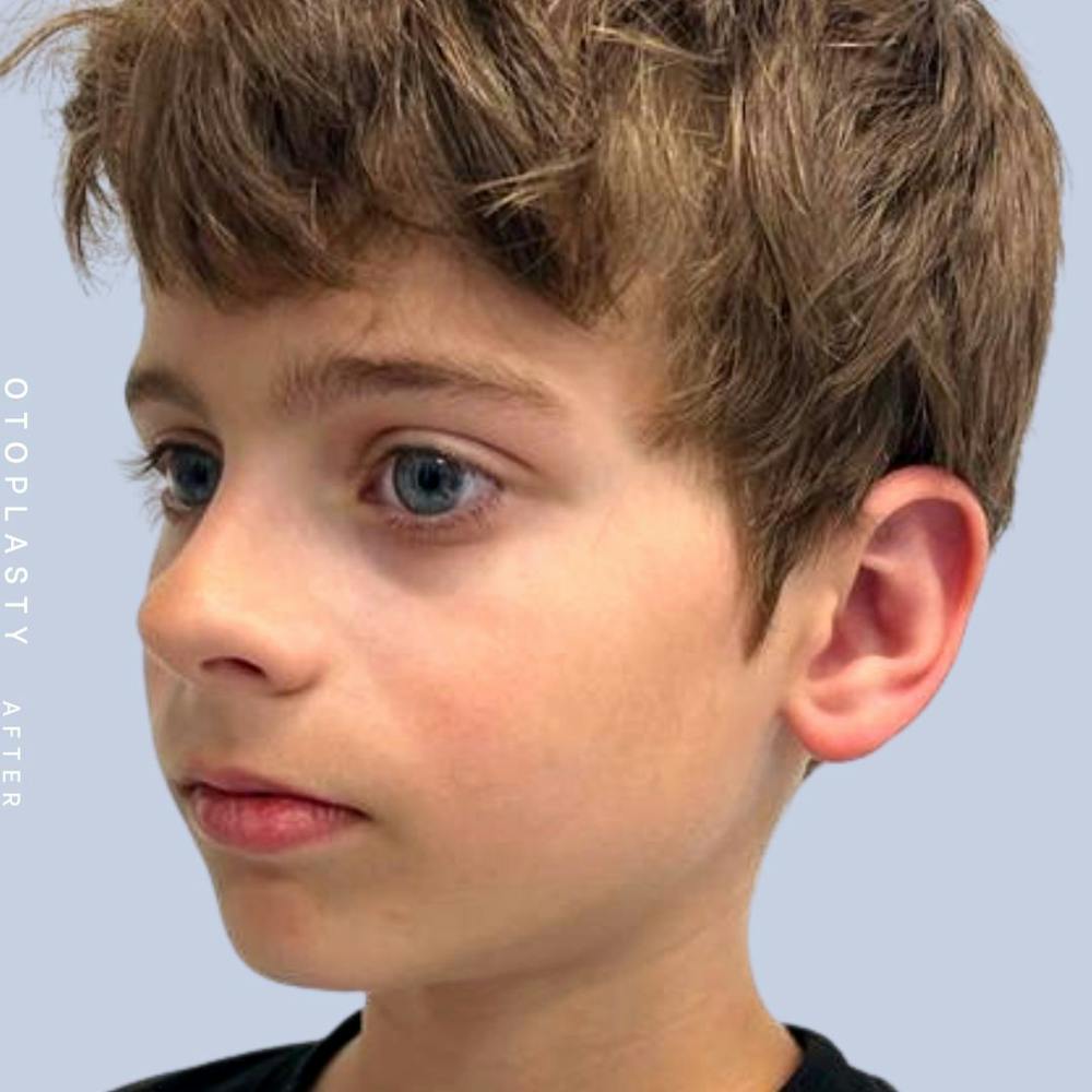 Ears Before & After Gallery - Patient 122542485 - Image 6