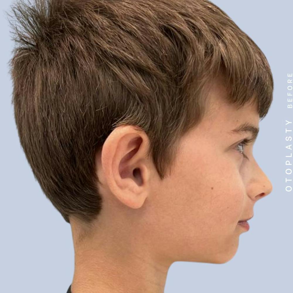 Ears Before & After Gallery - Patient 122542485 - Image 7