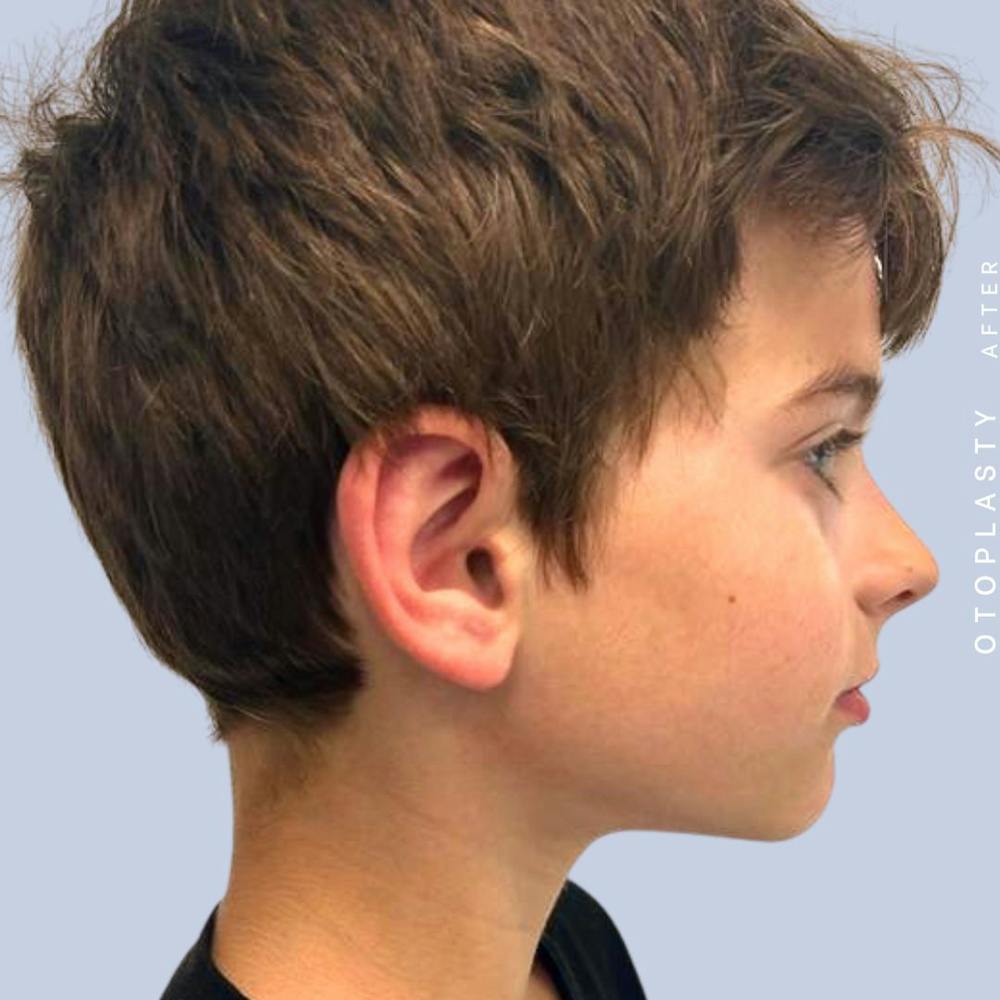 Ears Before & After Gallery - Patient 122542485 - Image 8