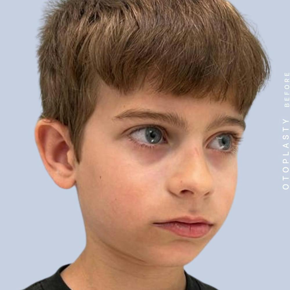 Ears Before & After Gallery - Patient 122542485 - Image 9