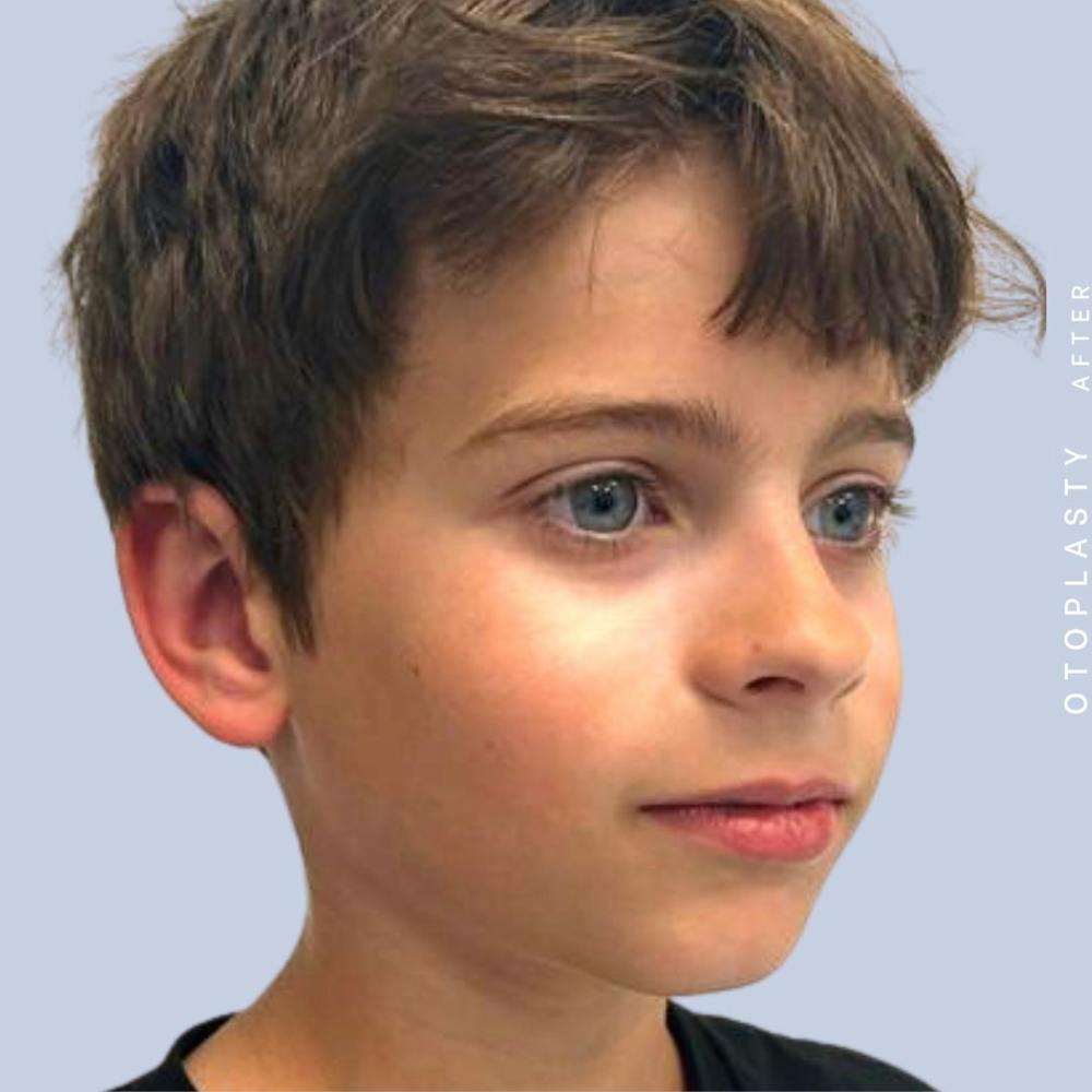 Ears Before & After Gallery - Patient 122542485 - Image 10