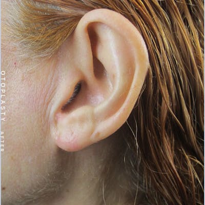 Ears Before & After Gallery - Patient 108744087 - Image 2