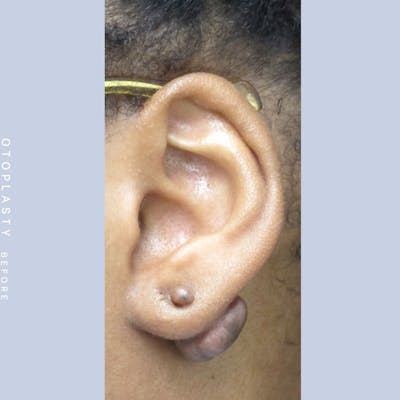 Ears Before & After Gallery - Patient 108744088 - Image 1