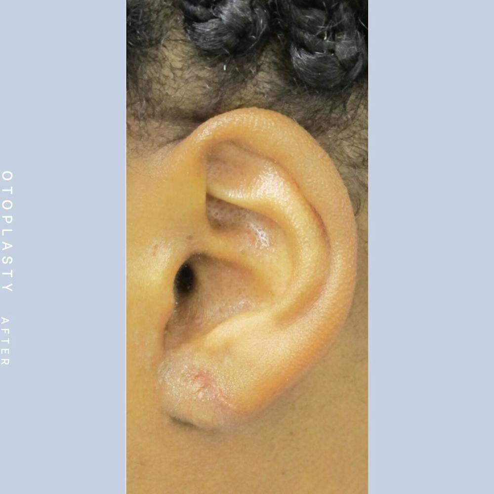 Ears Before & After Gallery - Patient 108744088 - Image 2
