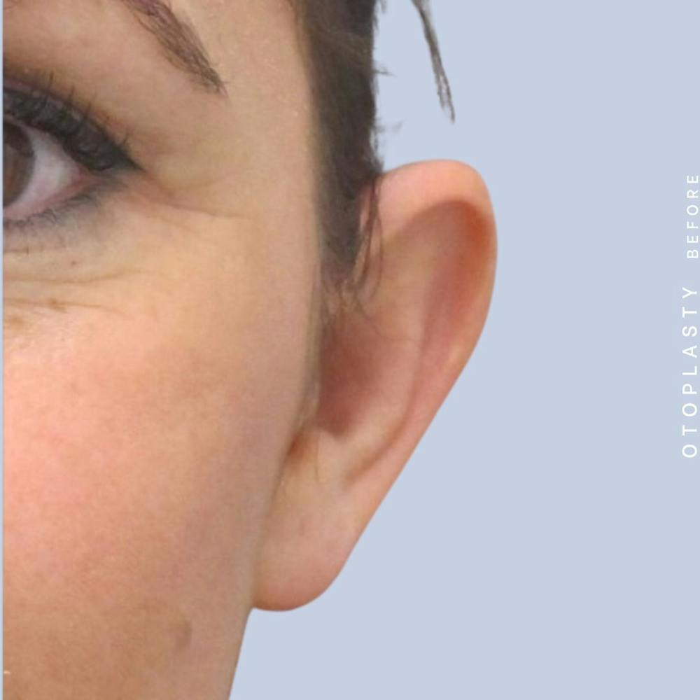 Ears Before & After Gallery - Patient 108744090 - Image 1
