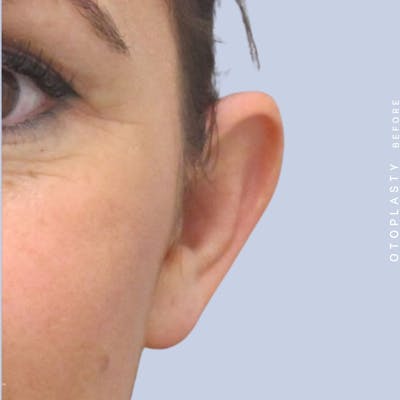 Ears Before & After Gallery - Patient 108744090 - Image 1