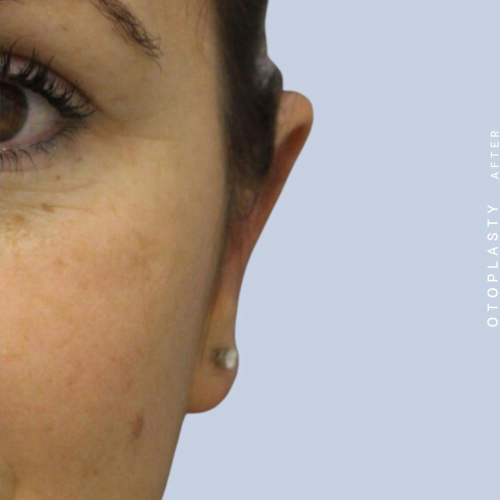 Ears Before & After Gallery - Patient 108744090 - Image 2