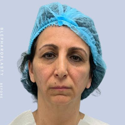 Eyes Before & After Gallery - Patient 122053872 - Image 1