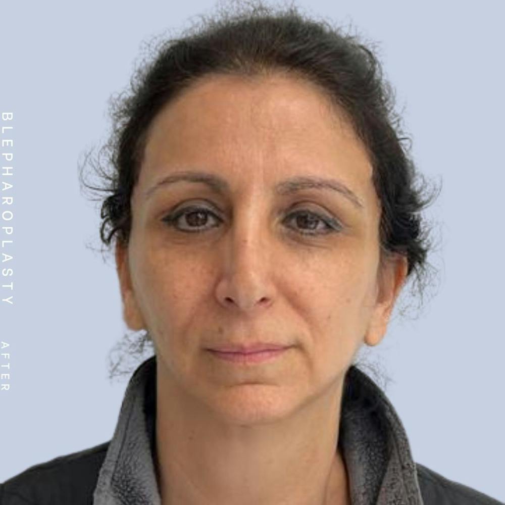 Eyes Before & After Gallery - Patient 122053872 - Image 2