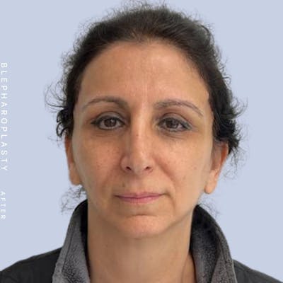 Eyes Before & After Gallery - Patient 122053872 - Image 2