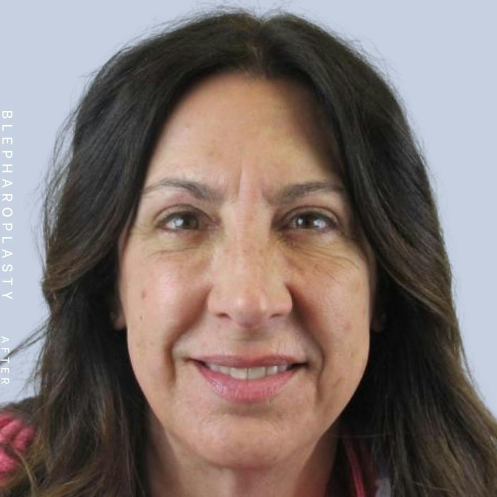 Eyes Before & After Gallery - Patient 122053818 - Image 2