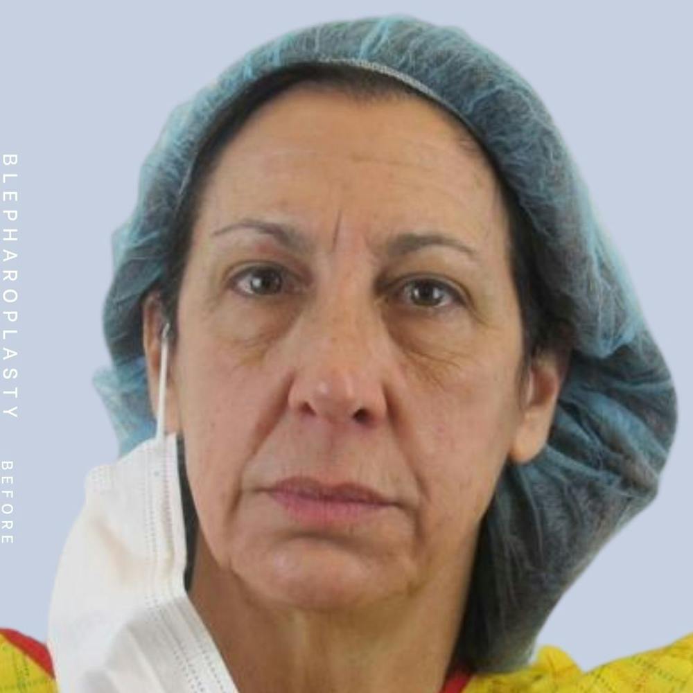 Eyes Before & After Gallery - Patient 122053818 - Image 3