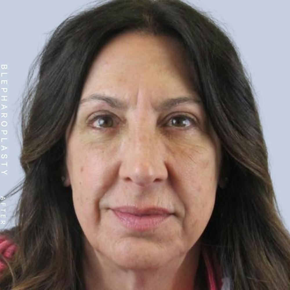 Eyes Before & After Gallery - Patient 122053818 - Image 4