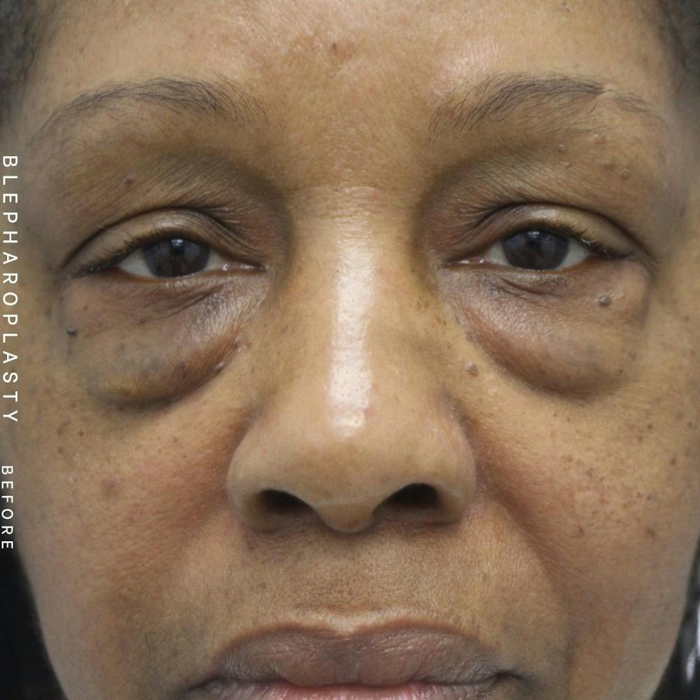 Eyes Before & After Gallery - Patient 108744015 - Image 1