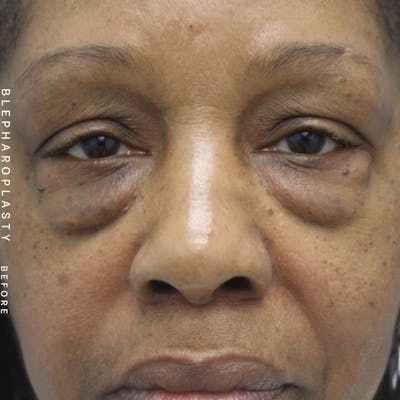 Eyes Before & After Gallery - Patient 108744015 - Image 1