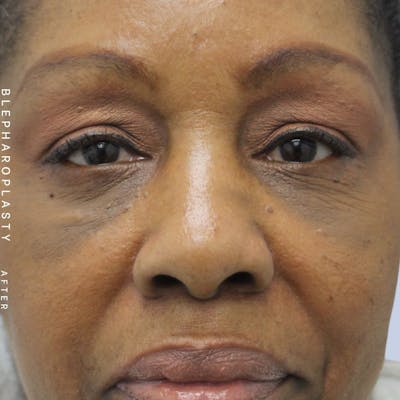 Eyes Before & After Gallery - Patient 108744015 - Image 2