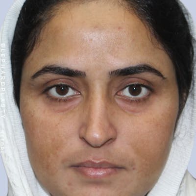 Eyes Before & After Gallery - Patient 108744017 - Image 1