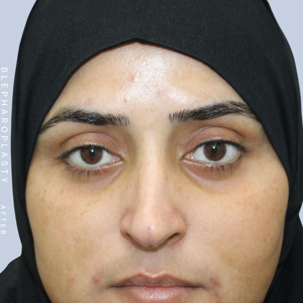 Eyes Before & After Gallery - Patient 108744017 - Image 2