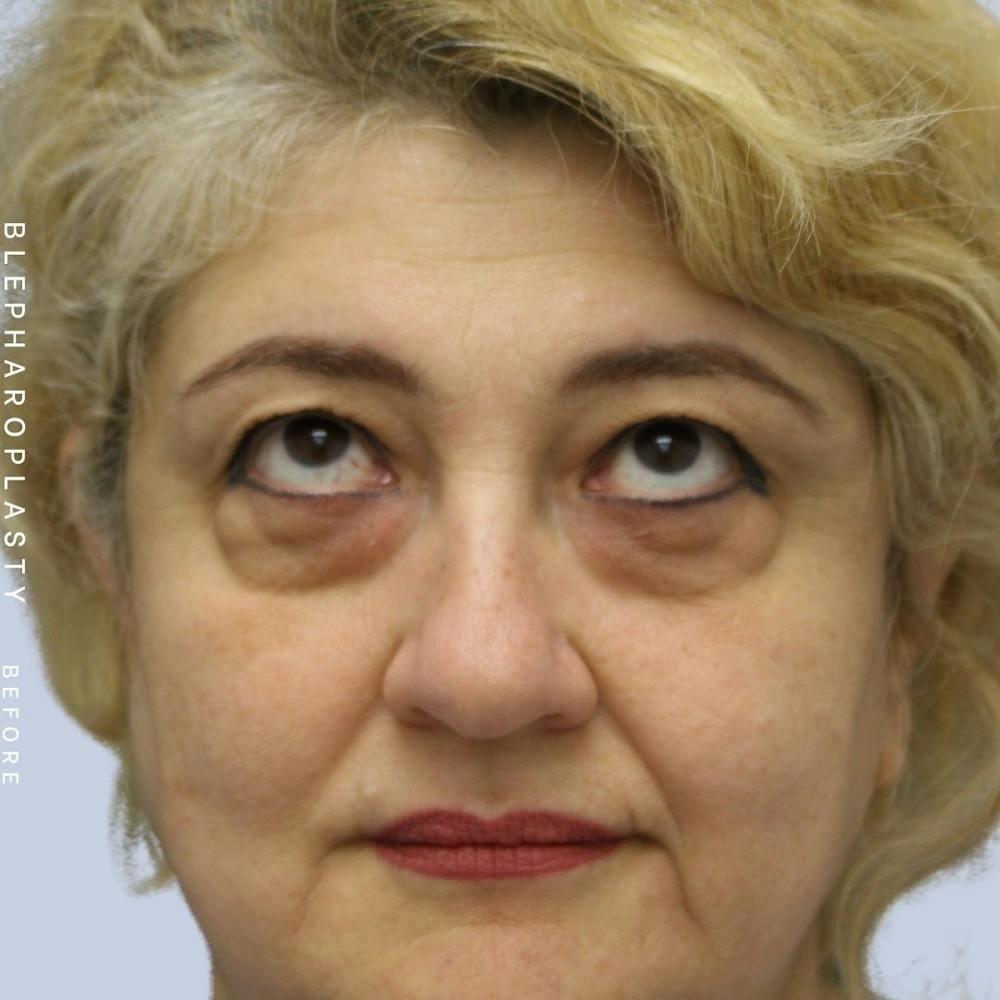 Eyes Before & After Gallery - Patient 108744018 - Image 1