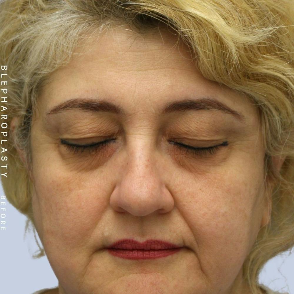 Eyes Before & After Gallery - Patient 108744018 - Image 3