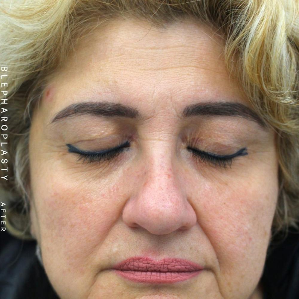 Eyes Before & After Gallery - Patient 108744018 - Image 4