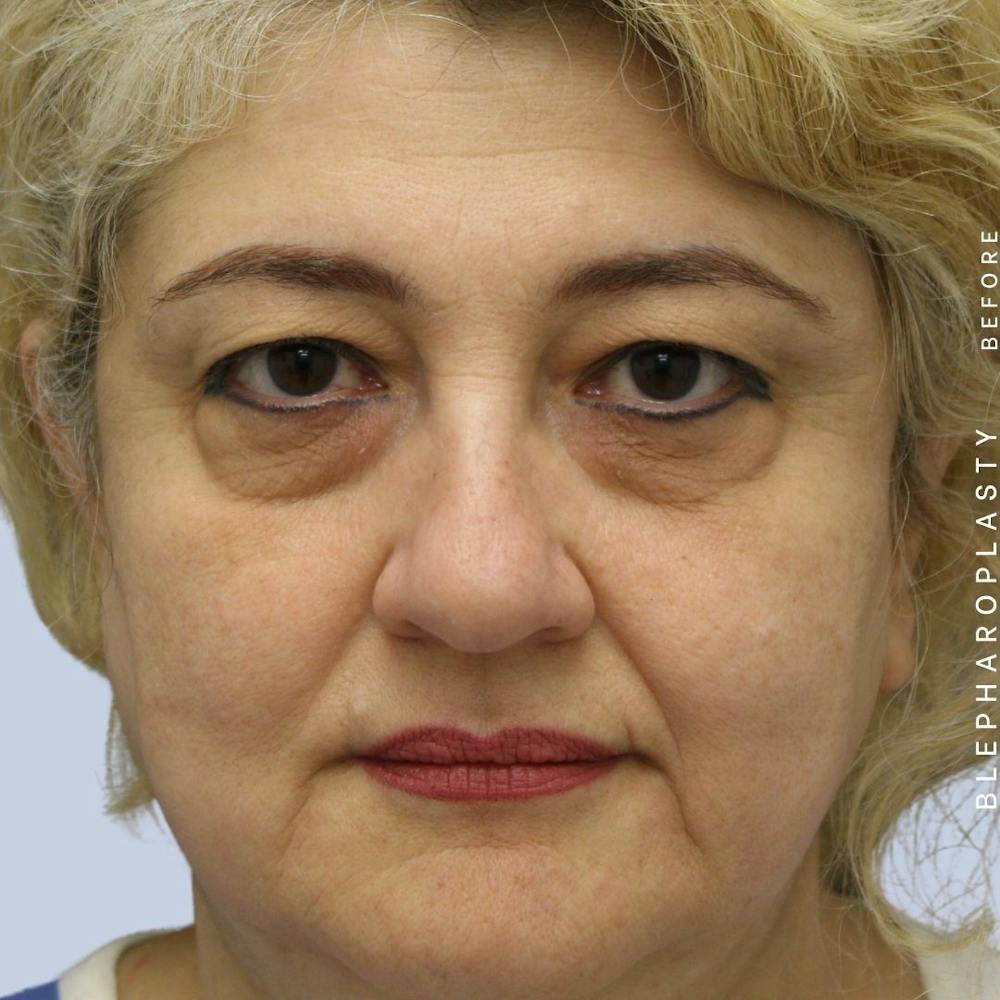 Eyes Before & After Gallery - Patient 108744018 - Image 5
