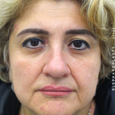 Eyes Before & After Gallery - Patient 108744018 - Image 6