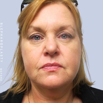 Eyes Before & After Gallery - Patient 108744043 - Image 1