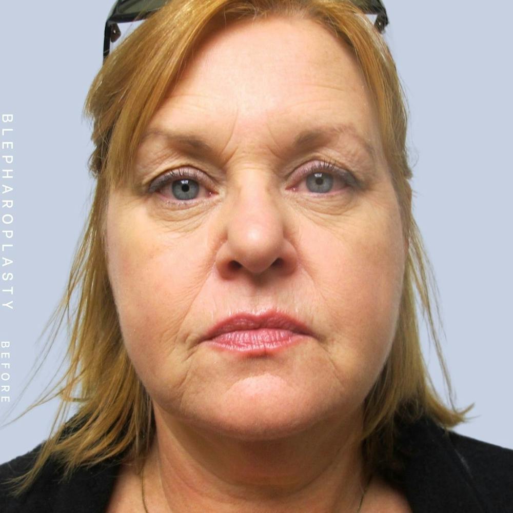 Eyes Before & After Gallery - Patient 108744043 - Image 1