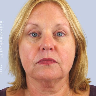 Eyes Before & After Gallery - Patient 108744043 - Image 2