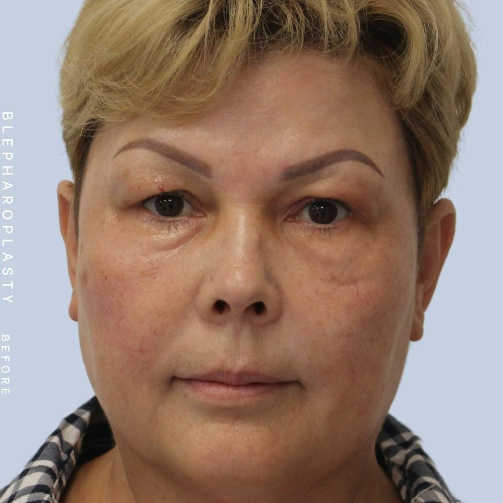Eyes Before & After Gallery - Patient 108744044 - Image 1