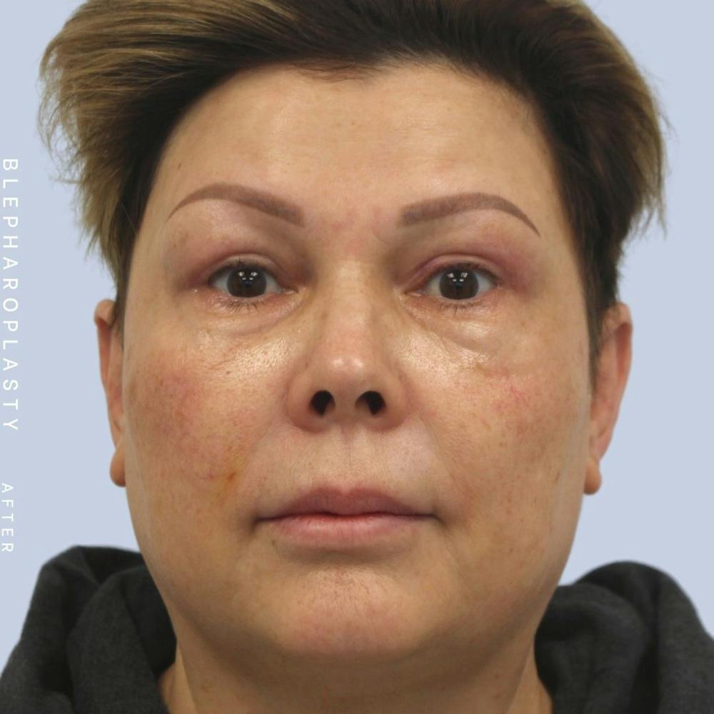 Eyes Before & After Gallery - Patient 108744044 - Image 2