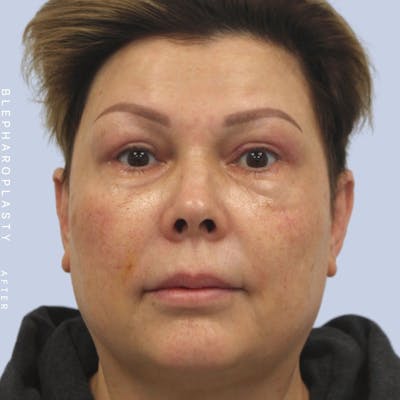 Eyes Before & After Gallery - Patient 108744044 - Image 2